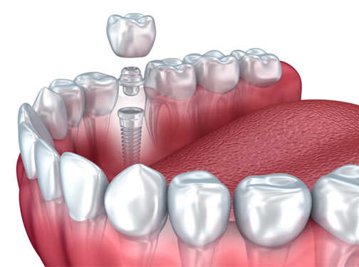 damrow_dental_implant